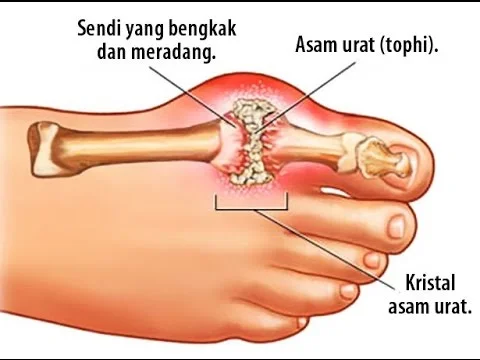 Gejala asam urat